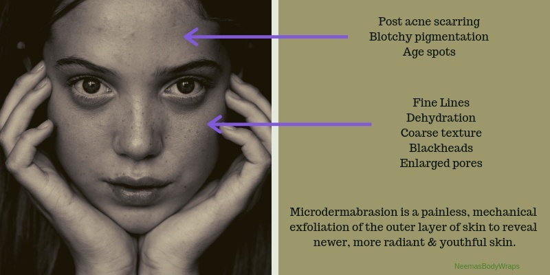 Microdermabrasion: Before