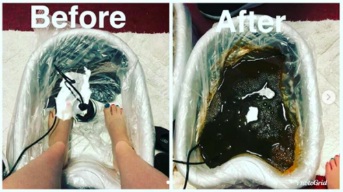 Ionic Foot Detox Before | After