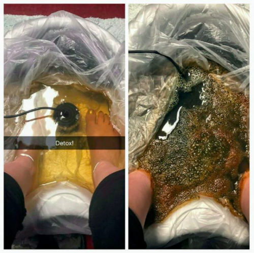 Ionic Foot Detox Before | After